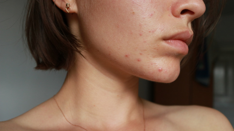 woman with acne problem 