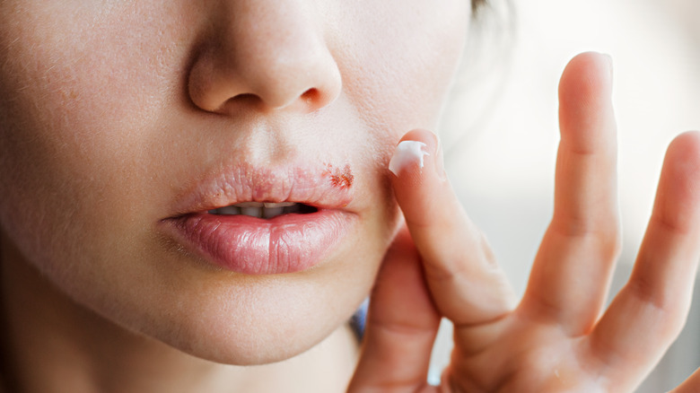 woman applying ointment on cold sore