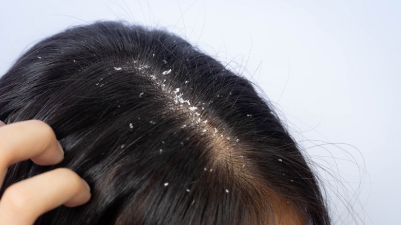 Dandruff flakes on scalp