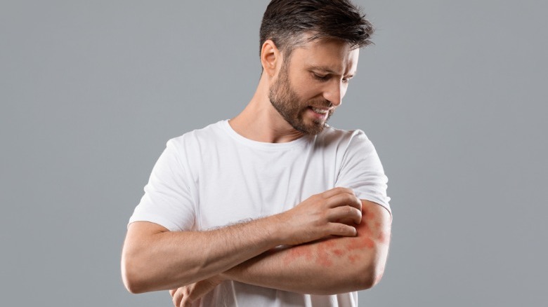 Man scratching eczema on arm