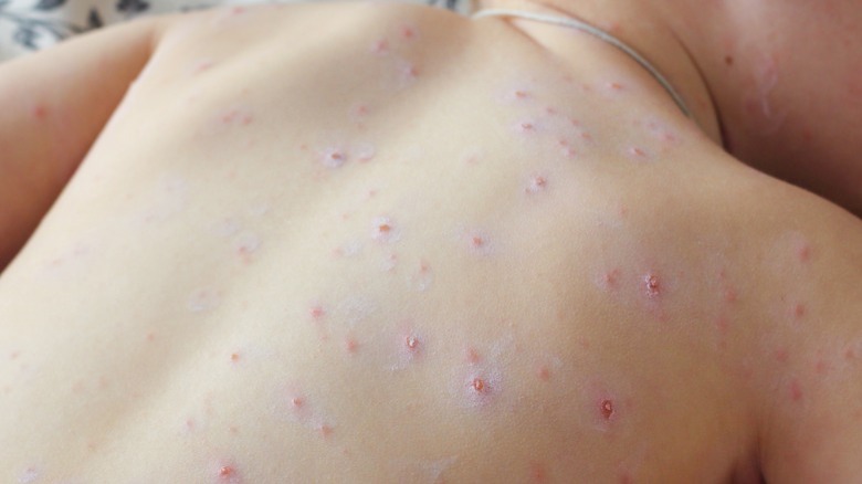 Child with chickenpox rash