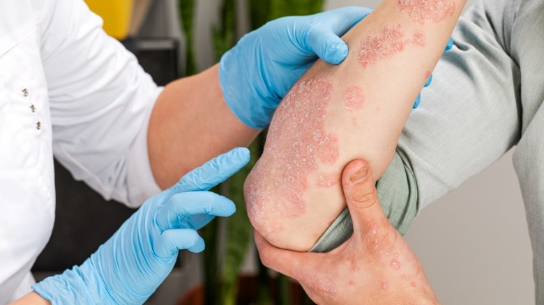 Doctor examining psoriasis rash