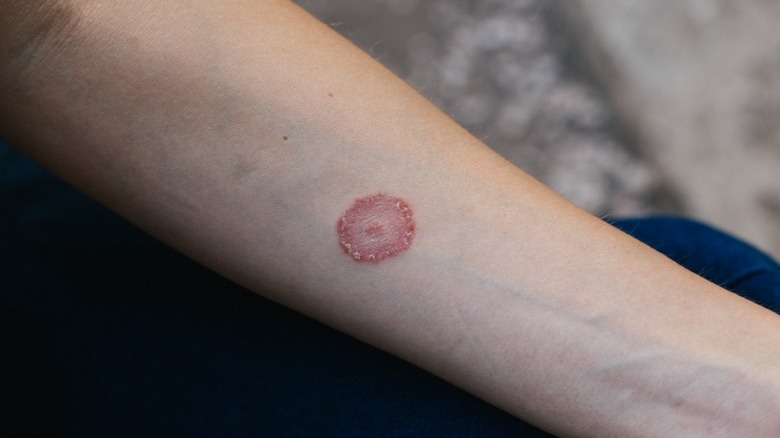 Ringworm infection on the arm