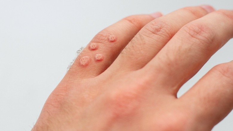 Warts on the hand