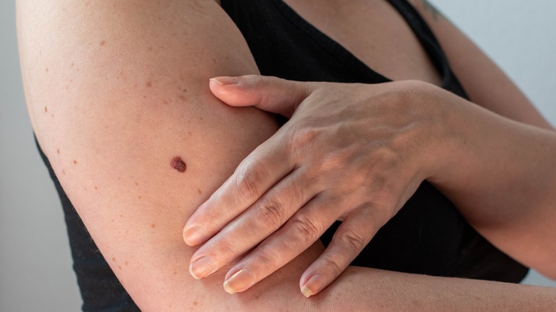 Woman with mole on upper arm