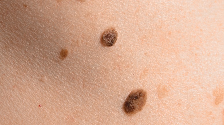 Close up of skin with several large moles