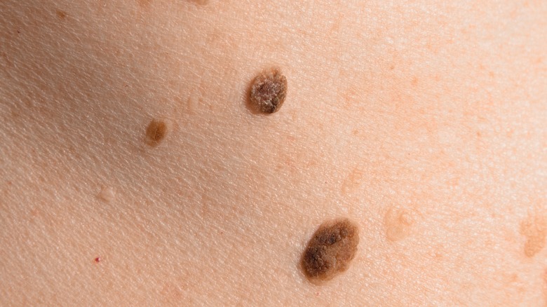 Common Types Of Moles And How To Tell When You Should Worry