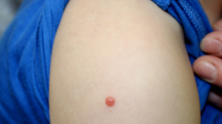 Non-pigmented or pink Spitz nevus on child's arm