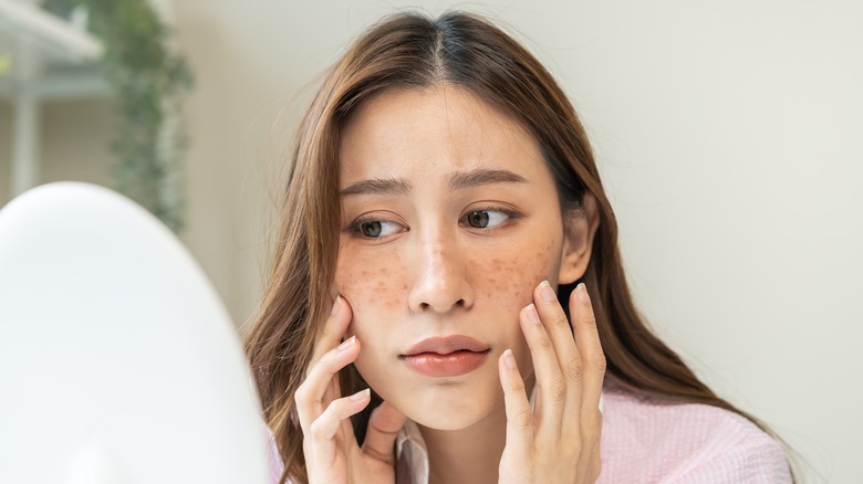 woman with acne