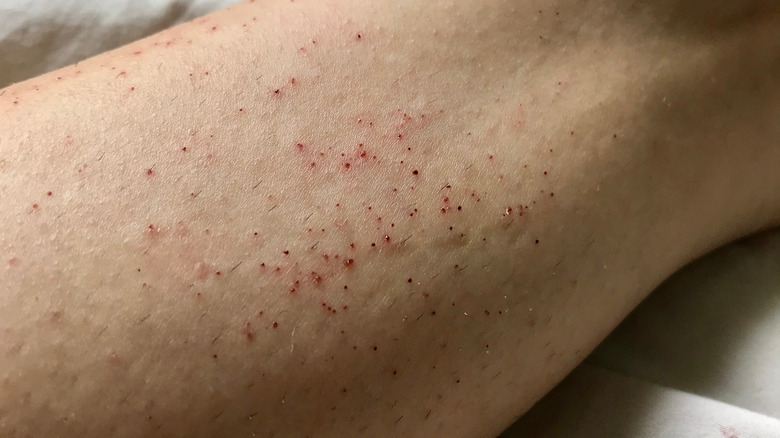 Razor burn on woman's leg