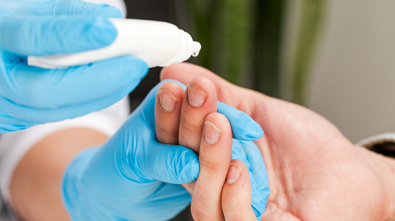 Dermatologist applying drops to nails