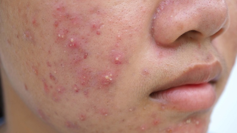 Person with cystic acne