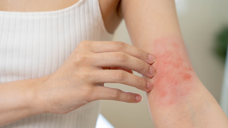 Woman examines eczema flare-up