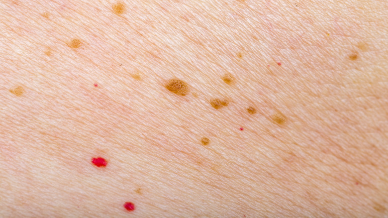 Cherry angiomas on human skin