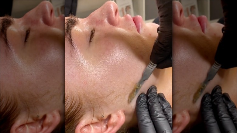 Woman getting dermaplaning treatment