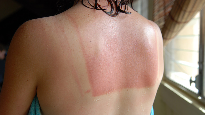 Woman with back sunburn