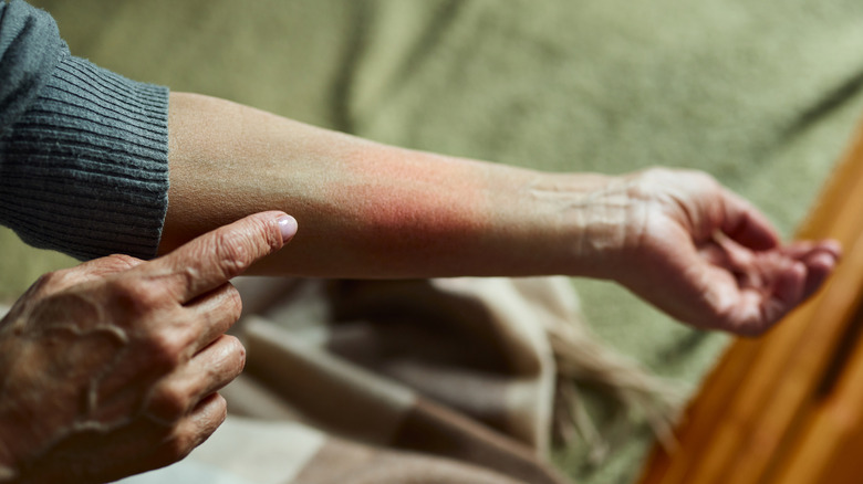 Woman with rash on arm