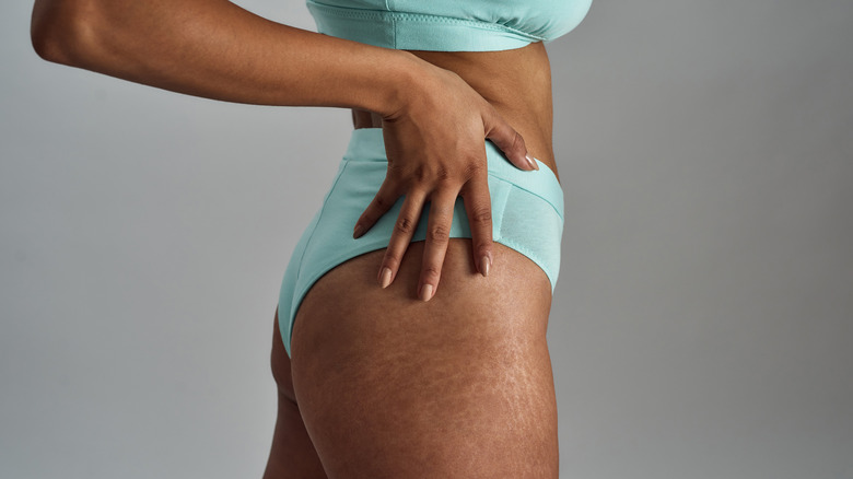 hip and buttocks stretch marks