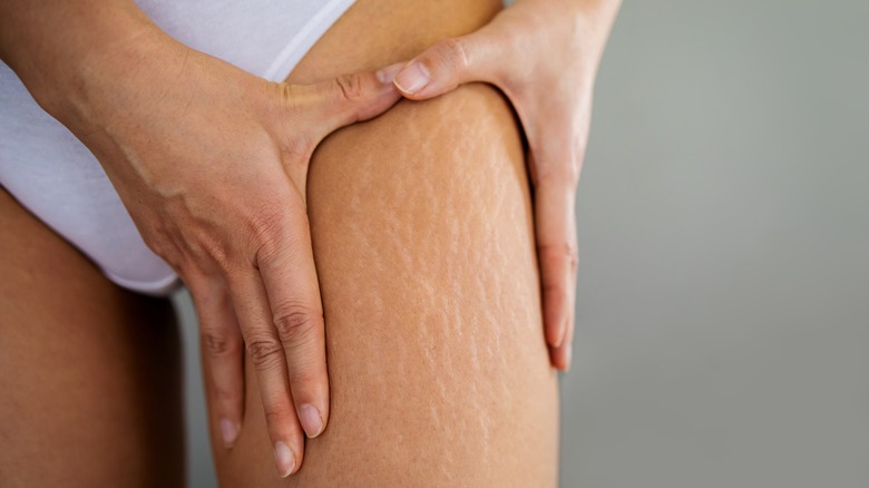 Does Retinol Help With Stretch Marks 