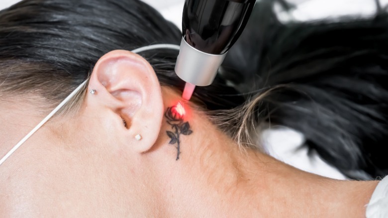 Woman getting rose tattoo removed