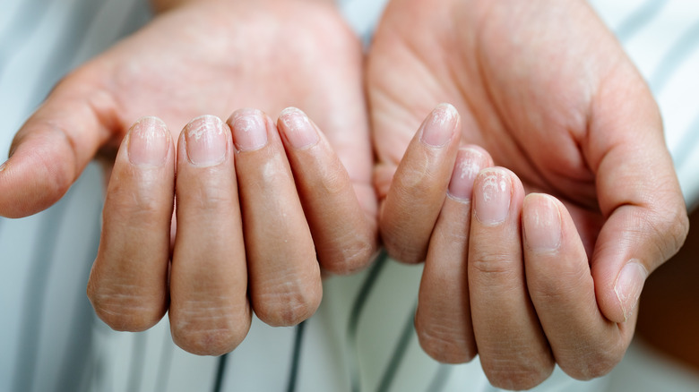 Damaged fingernails post manicure