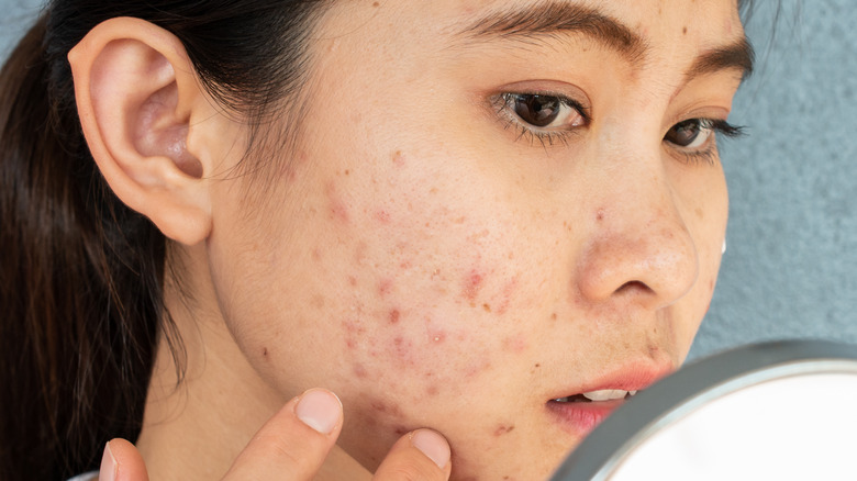 woman looking at her acne
