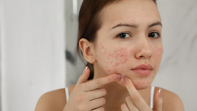 Woman with acne inspecting her face