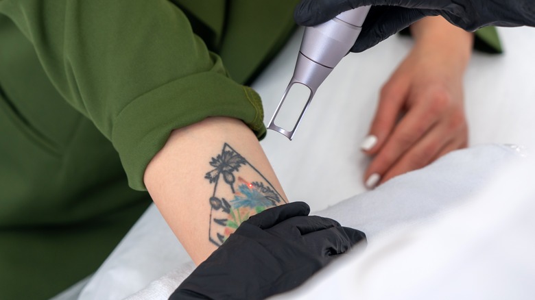 undergoing laser tattoo removal