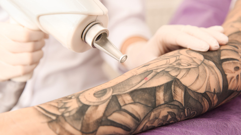 laser removing tattoo on arm