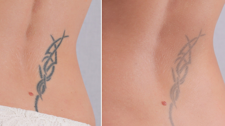 laser tattoo removal on back 