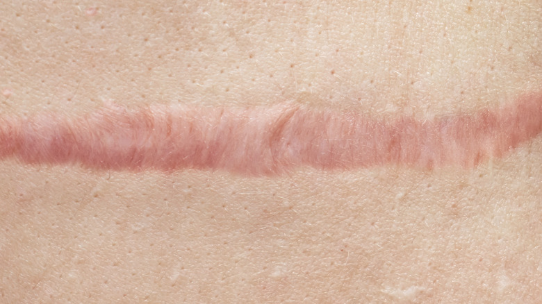 Close up of keloid scar 