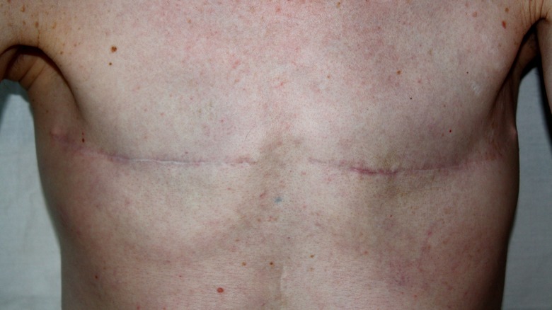 Chest with scars from top surgery