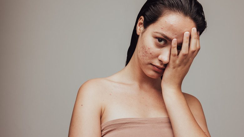 Woman with acne covering one half of her face