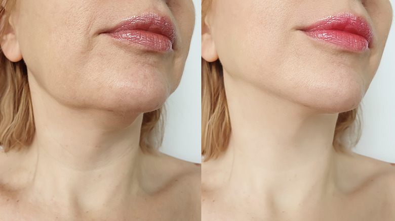 A woman before and after skin tightening