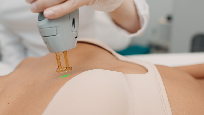 laser hair removal on chest 