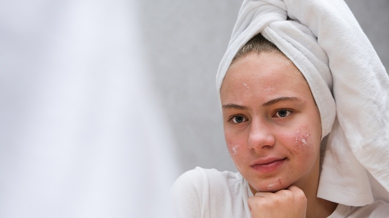 Woman with acne scar cream