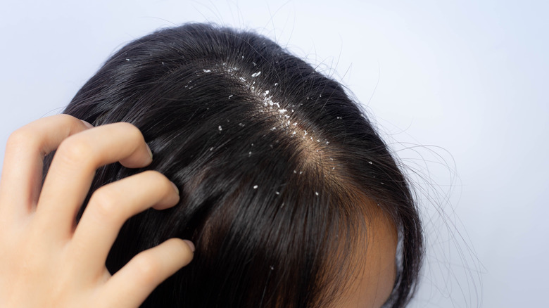 Girl with itchy head and dandruff 