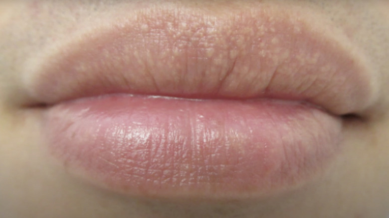 fordyce spots on upper lip