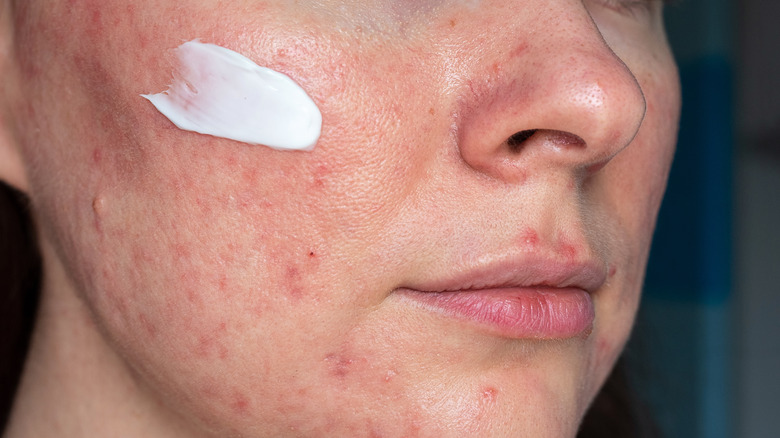 woman with rosacea