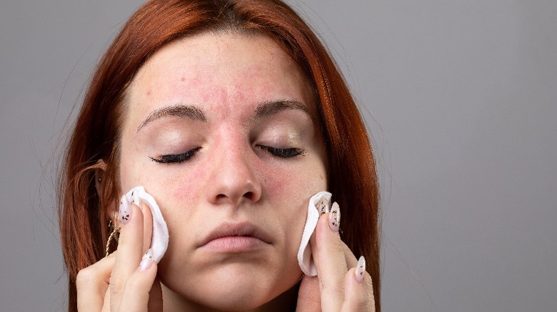 Woman with red, irritated cheeks using cosmetic pads