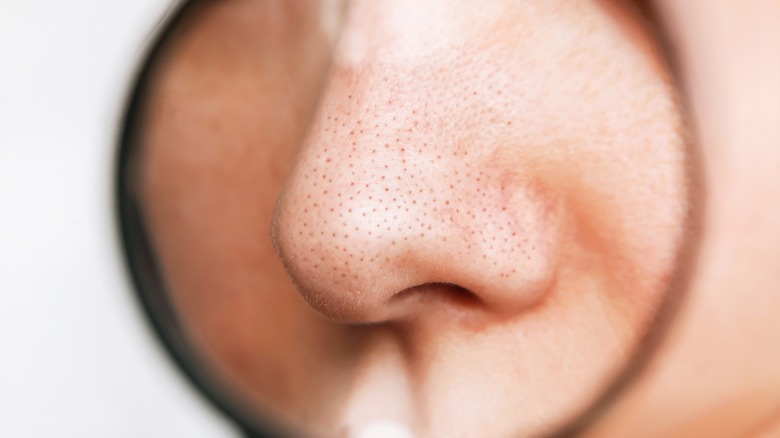 enlarged pores and blackheads magnified