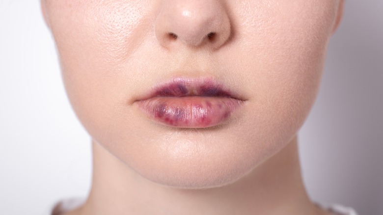 Woman with bruising after lip filler