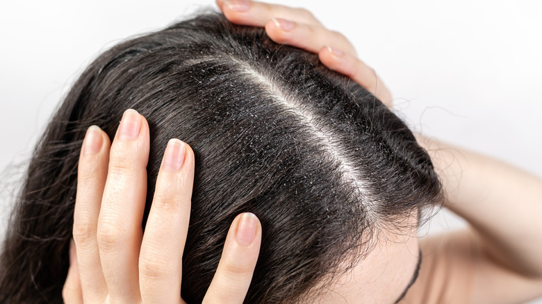 Woman with dandruff