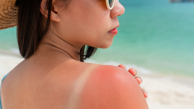 Woman with a sunburnt shoulder 