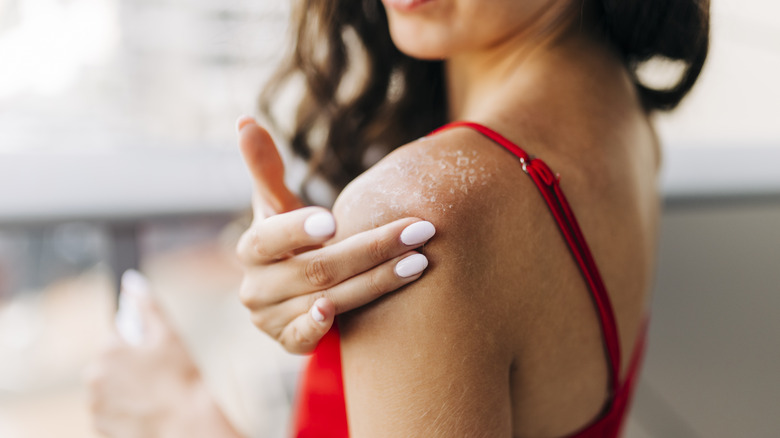 woman applying balm to sunburn