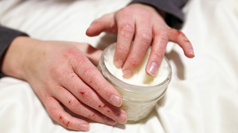 dry hand holding moisturizer