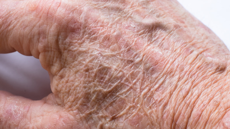 close up of hand with sunspot