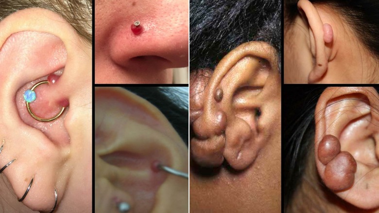 Piercing bumps and keloids