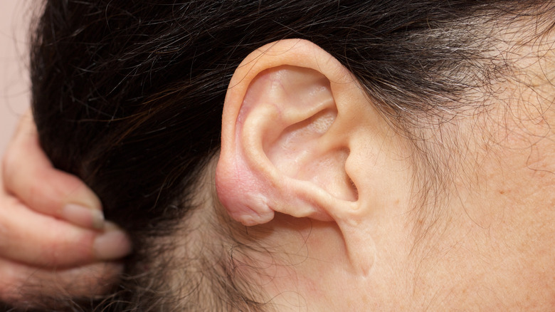 earlobe with keloid from piercing