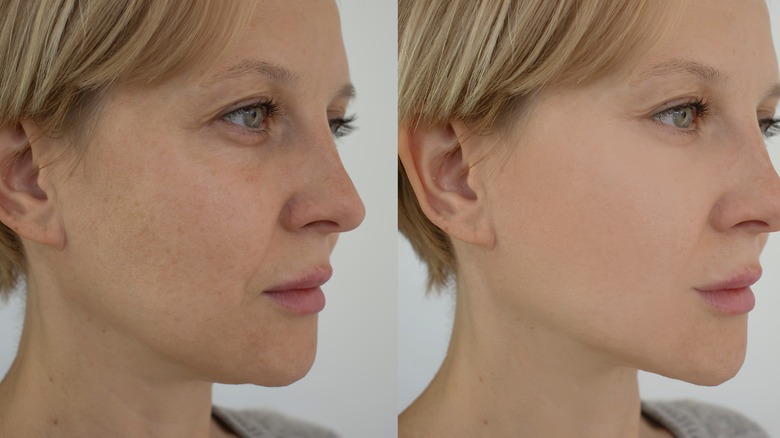 Woman before and after facial liposuction